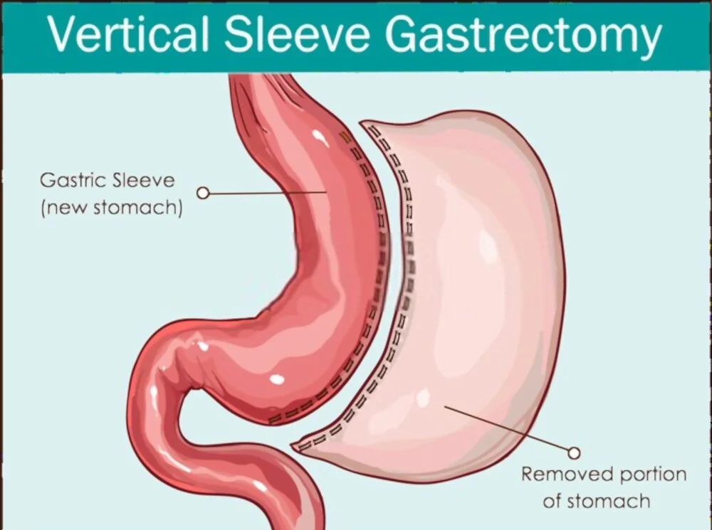 Sleeve gastrique: 8 conseils pour se préparer pour une sleeve (Partie 2)