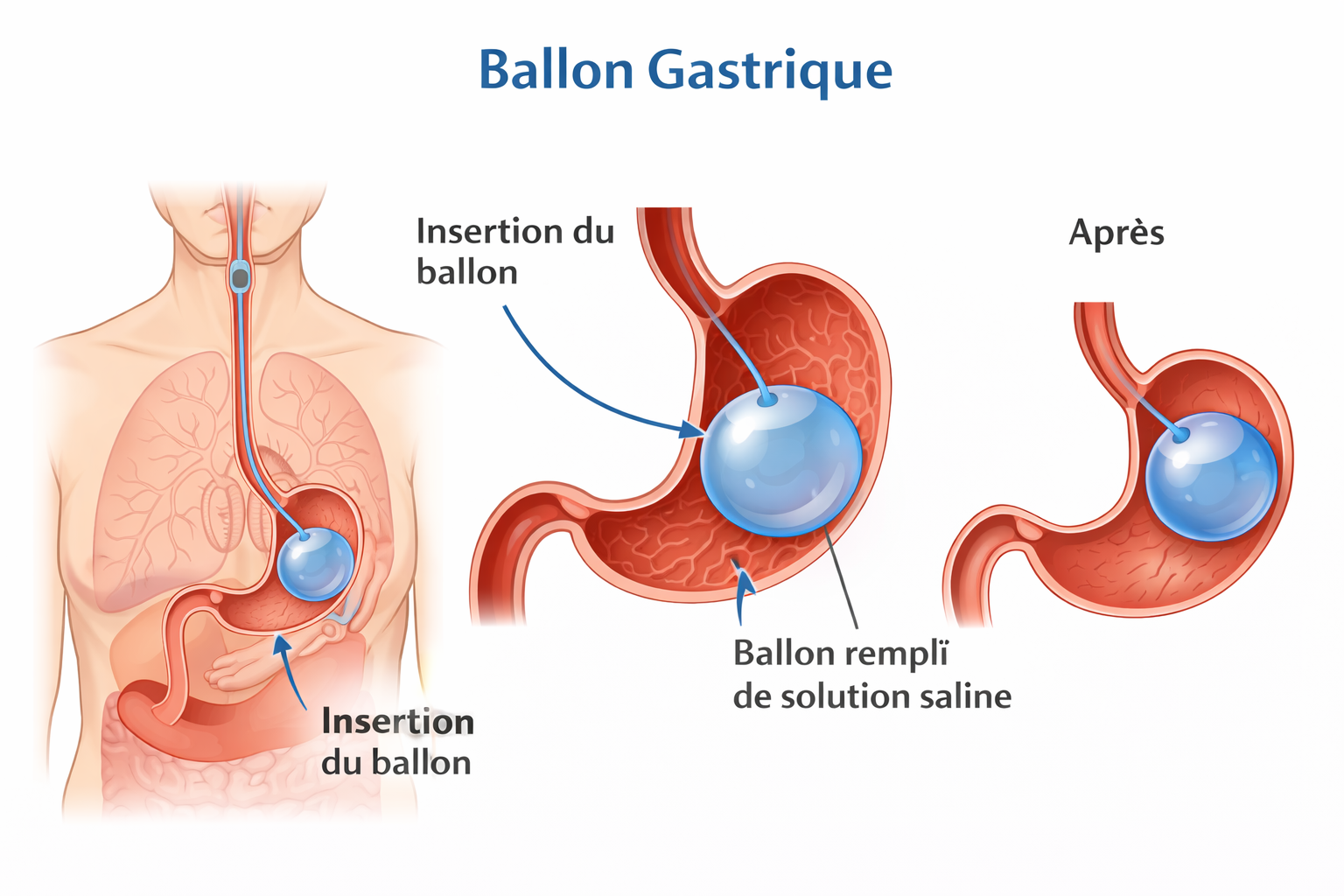 Ballon gastrique : Se sentir rassasié pour mieux maigrir ?