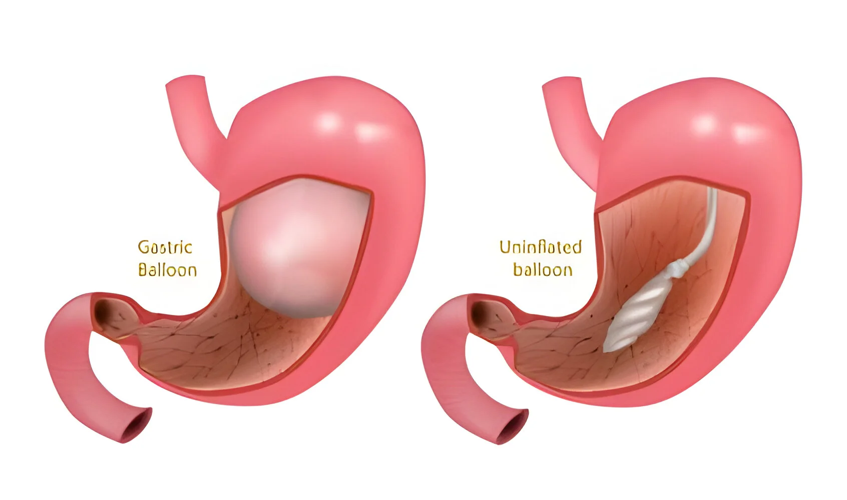 Ballon gastrique : Se sentir rassasié pour mieux maigrir ?