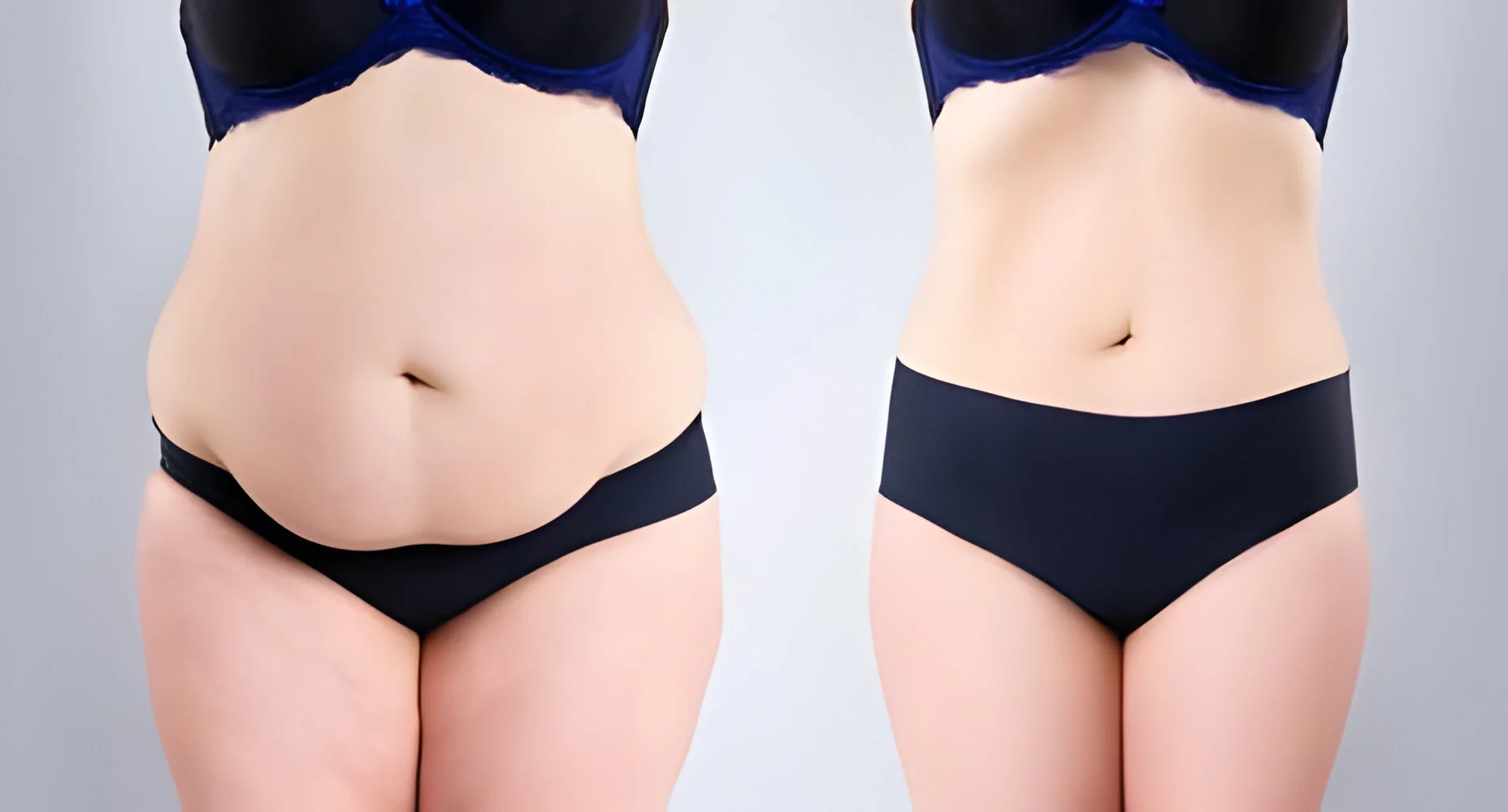 Ventre plat : La Tummy Tuck, une solution durable ?