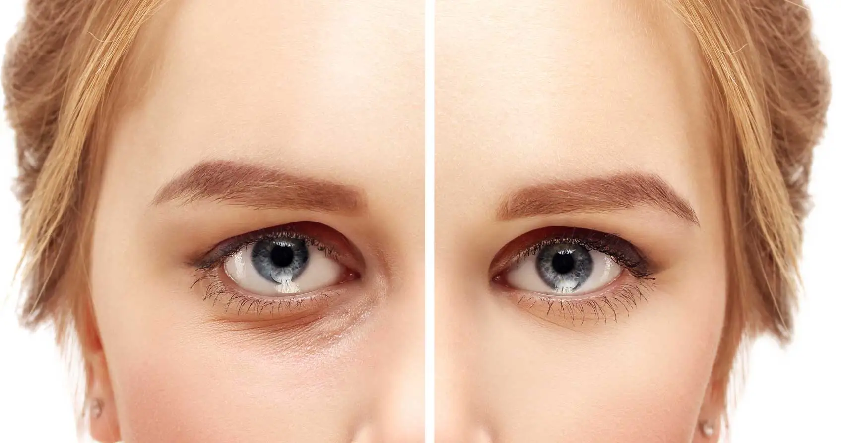 Rajeunissement du regard grâce à une blépharoplastie des paupières en Tunisie