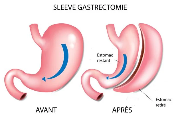 Illustration des effets de la sleeve gastrectomie en Tunisie sur la perte de poids