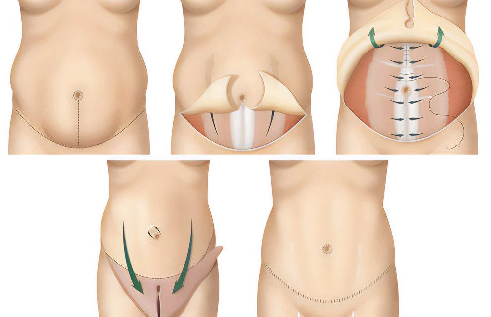 Résultat esthétique d'une abdominoplastie en Tunisie après grossesse ou perte de poids