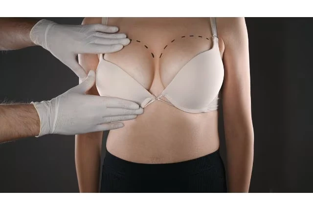 Résultat naturel d'une augmentation mammaire en Tunisie avec implants pour sublimer la silhouette.