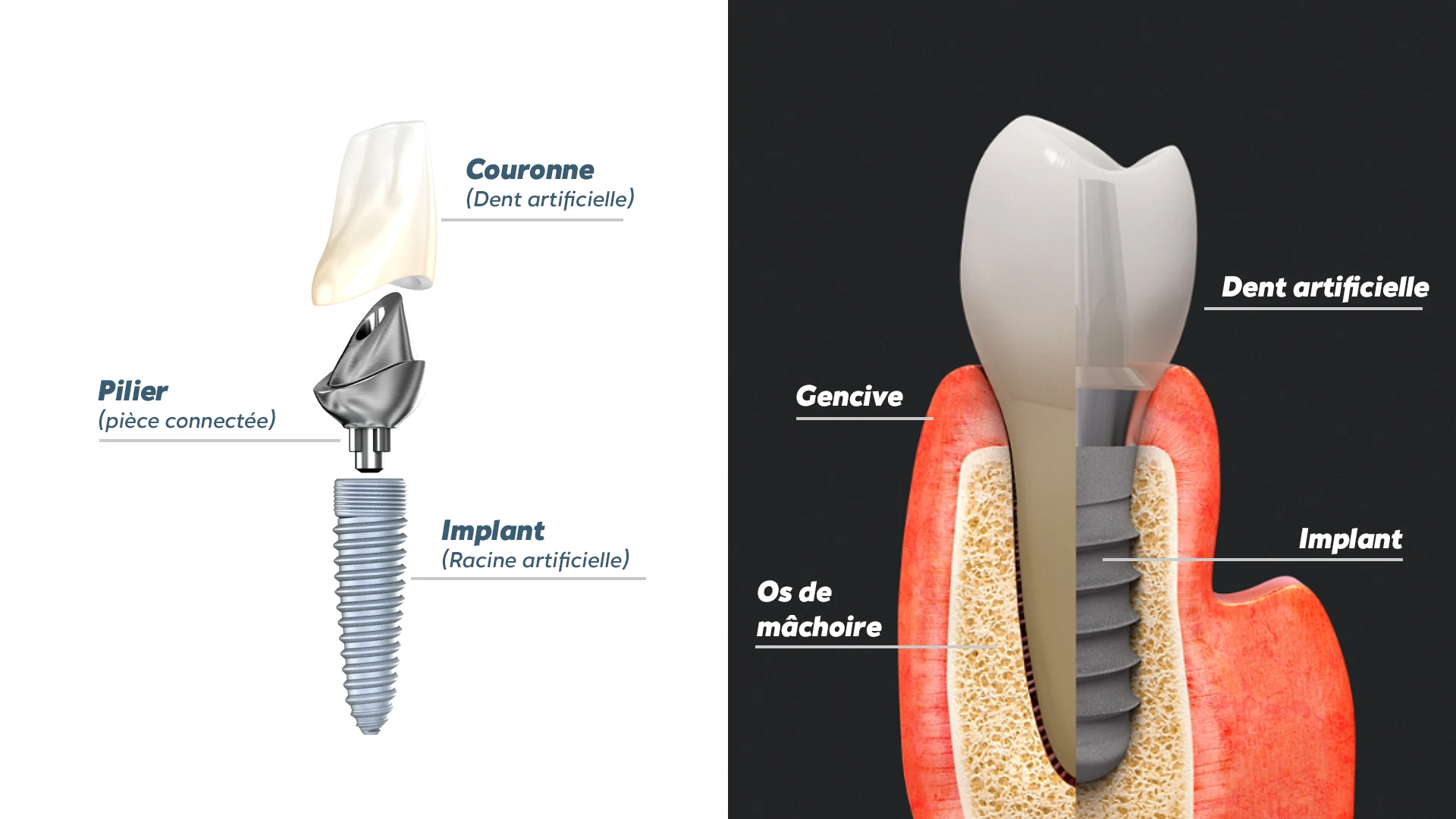 Vue d'un implant dentaire en Tunisie pour remplacer une dent manquante durablement