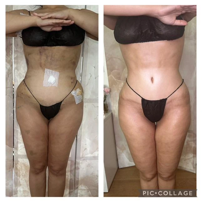 Résultat d'une liposuccion 360 degrés en Tunisie pour une silhouette harmonieuse