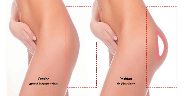 Résultat avant et après augmentation fessière en Tunisie : fesses galbées et harmonieuses