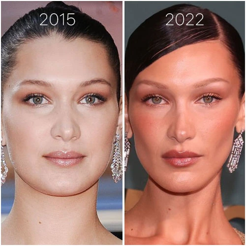 Bichectomie Tunisie pour affiner les joues et redessiner l’ovale du visage avec Medica Tour