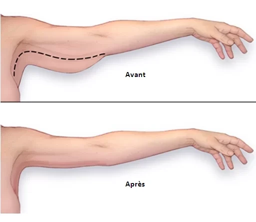 Séjour médical en Tunisie pour lifting des bras avec prise en charge par Medica Tour