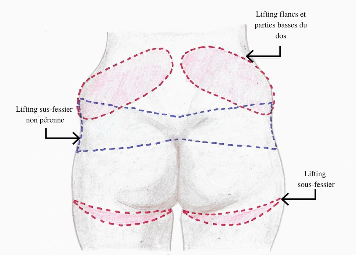 Résultat avant et après lifting des cuisses en Tunisie : cuisses raffermies et silhouette affinée