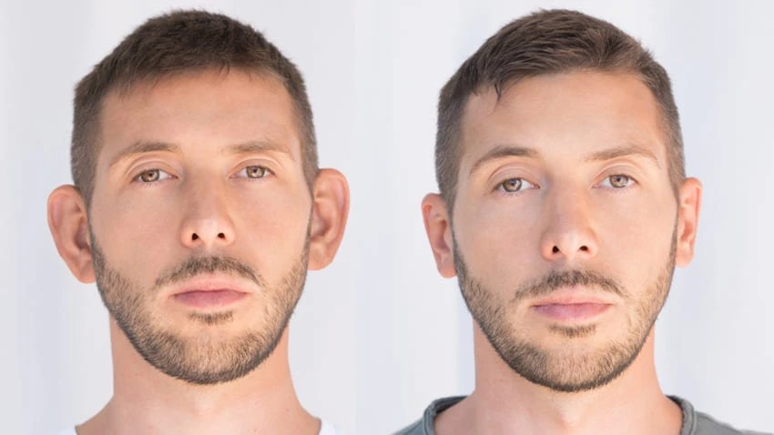 Résultat avant et après otoplastie en Tunisie : oreilles repositionnées et symétriques