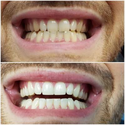 Résultat avant après blanchiment dentaire Tunisie – dents plus blanches et naturelles.