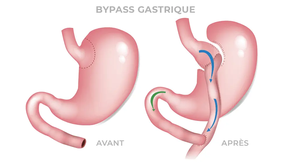 Bypass gastrique Tunisie – chirurgie bariatrique pour perte de poids durable.