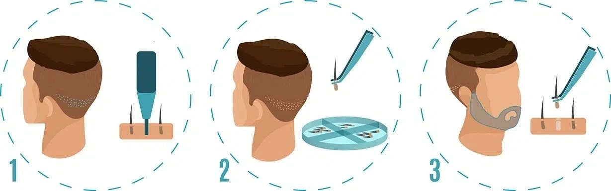 Greffe de barbe Tunisie – densification pilosité faciale homme Medica Tour