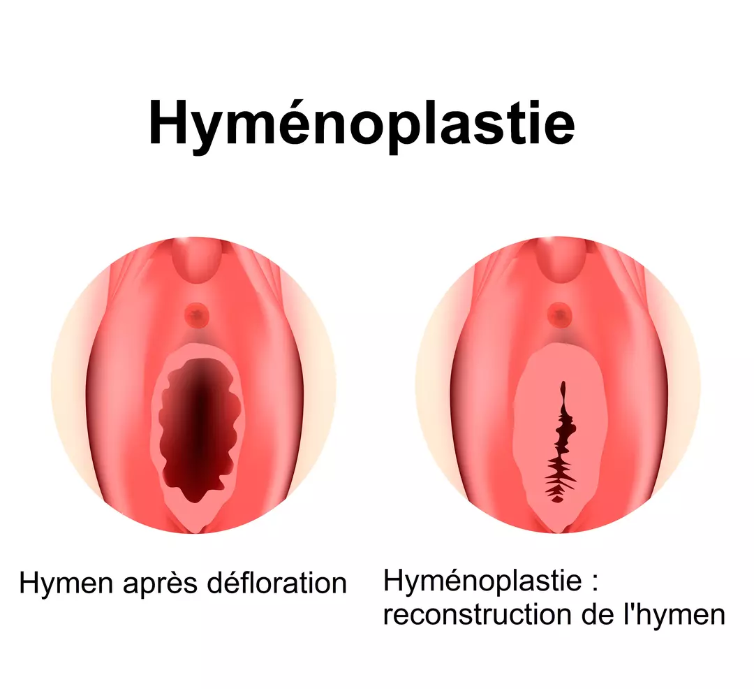Clinique hyménoplastie Tunisie – procédure rapide et sécurisée.