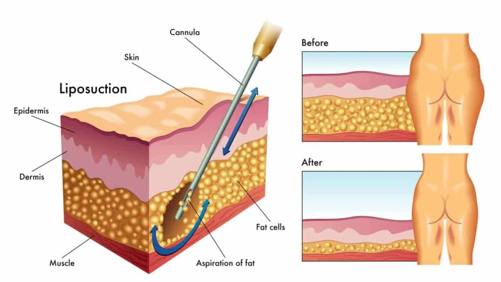 Clinique liposuccion VASER Tunisie – technique douce pour sculpter le corps .