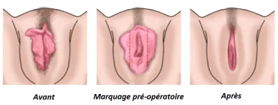 Clinique nymphoplastie Tunisie – intervention intime avec confort et discrétion.