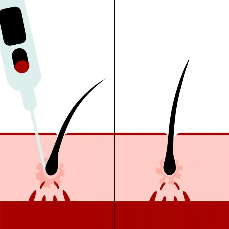 Traitement PRP cheveux Tunisie – injection plasma riche plaquettes stimulation repousse