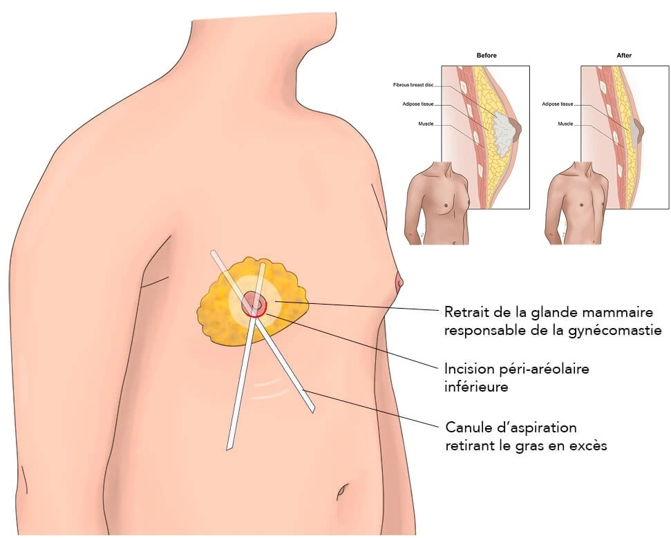 Traitement de la gynécomastie par chirurgie esthétique en Tunisie