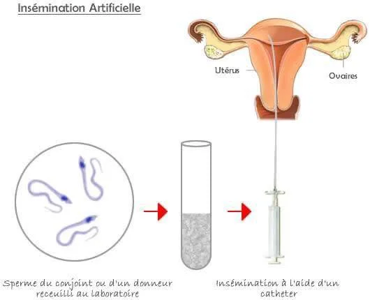 Principe de l’insémination artificielle dans le cadre de la PMA en Tunisie