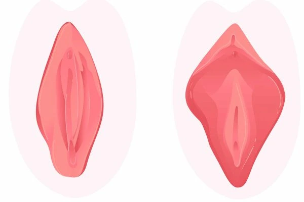 Lipofilling des grandes lèvres en Tunisie : réinjection de graisse pour restaurer le volume intime et rajeunir la zone génitale