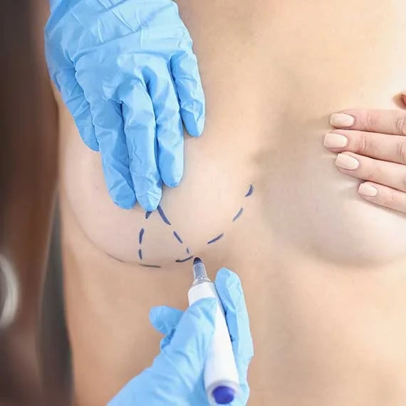 Préparation du lipofilling mammaire par injection de graisse pour augmentation naturelle