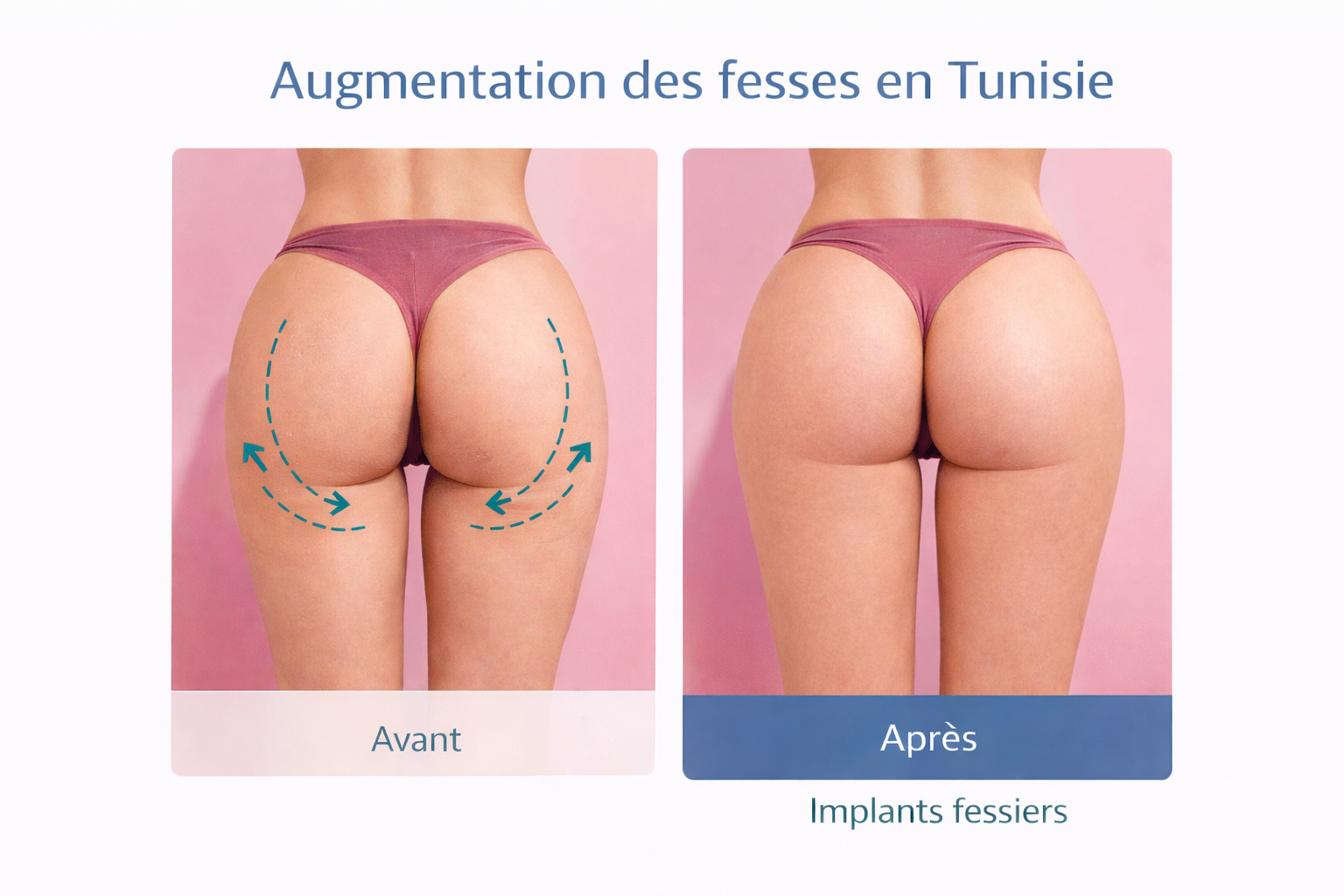 Résultat avant et après augmentation des fesses par implants en Tunisie – fessier galbé et projection améliorée