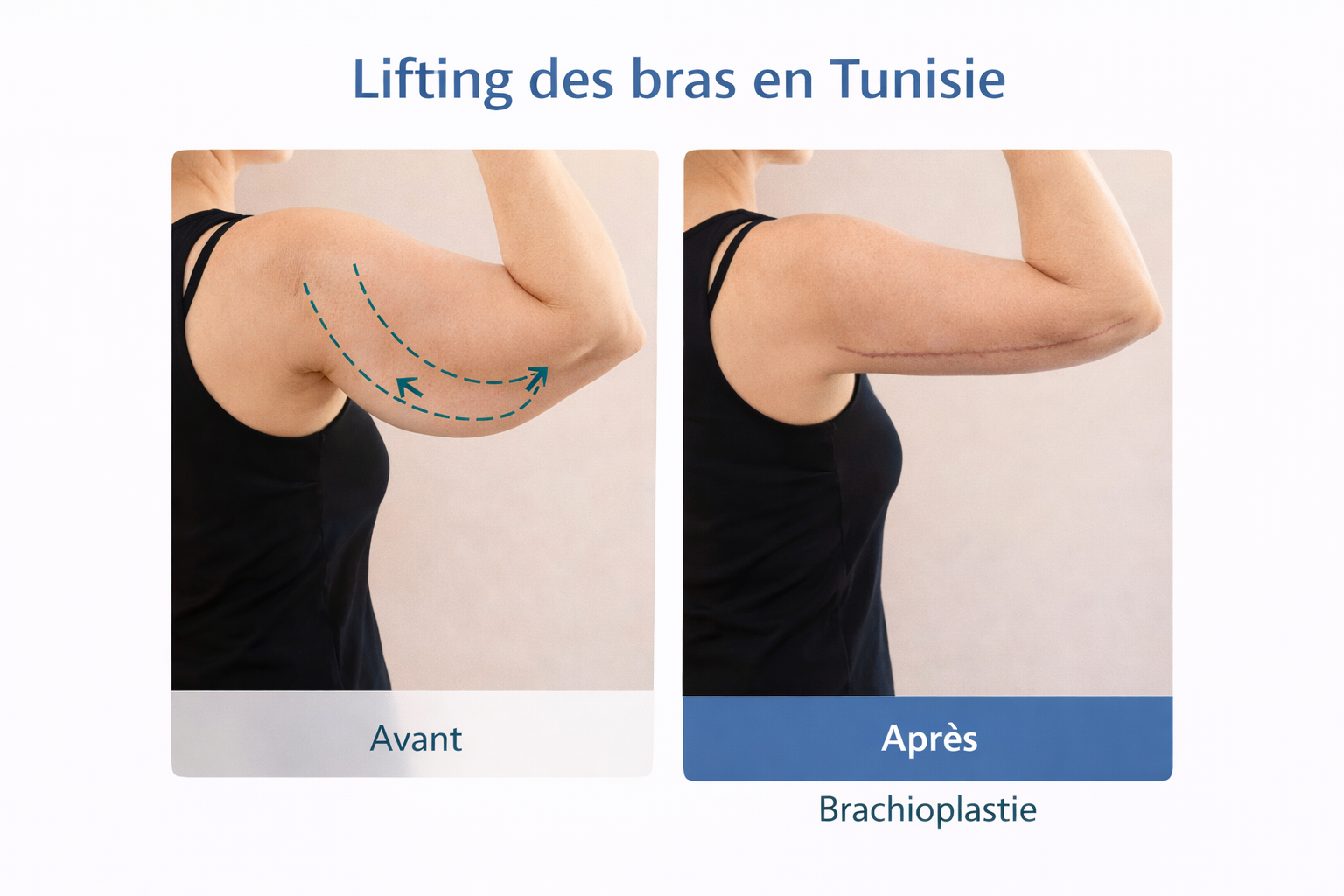 Résultat d’un lifting des bras en Tunisie après brachioplastie pour corriger le relâchement cutané