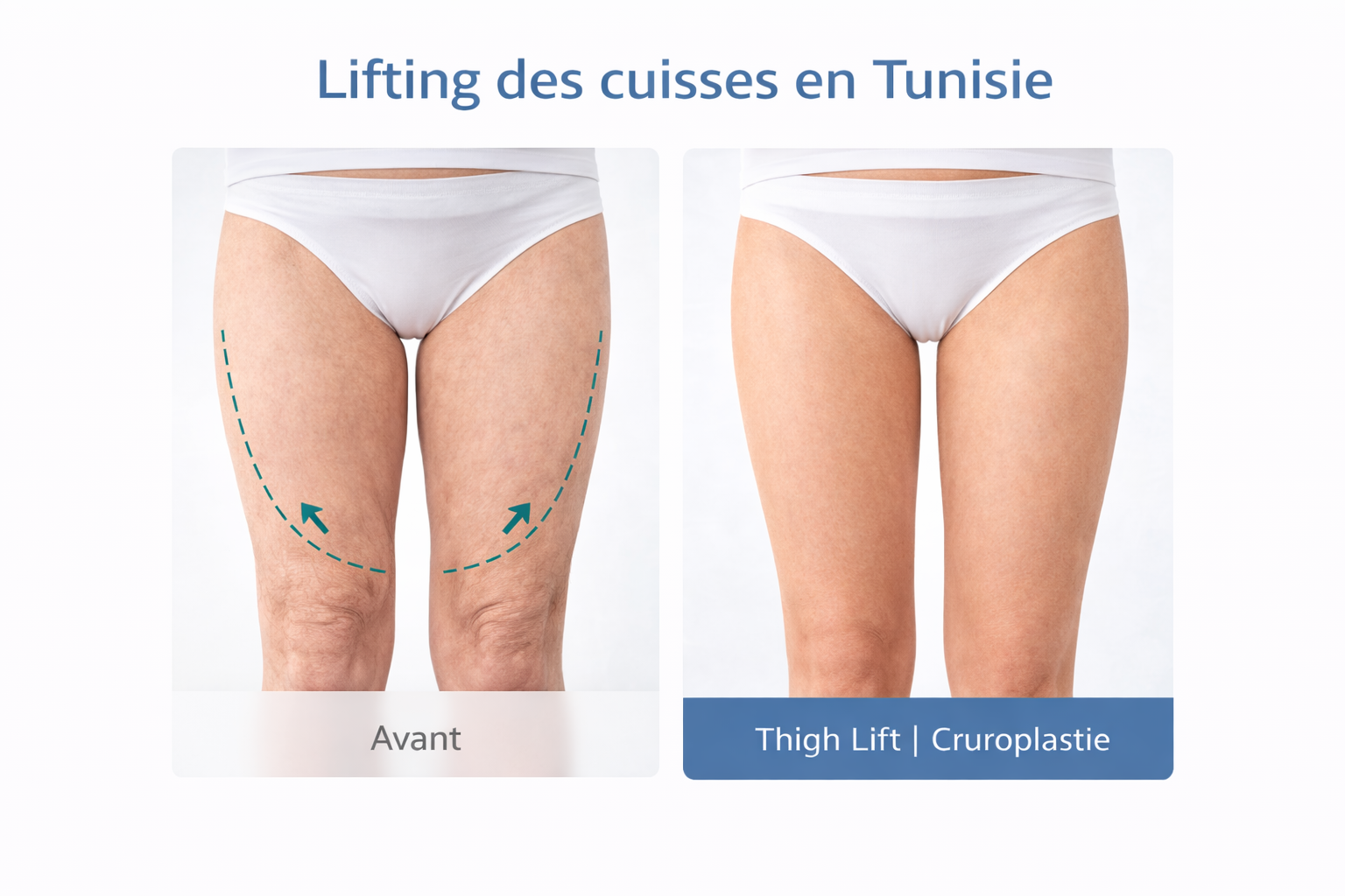 Résultat d’un lifting des cuisses en Tunisie – raffermissement et remise en tension de la face interne des cuisses