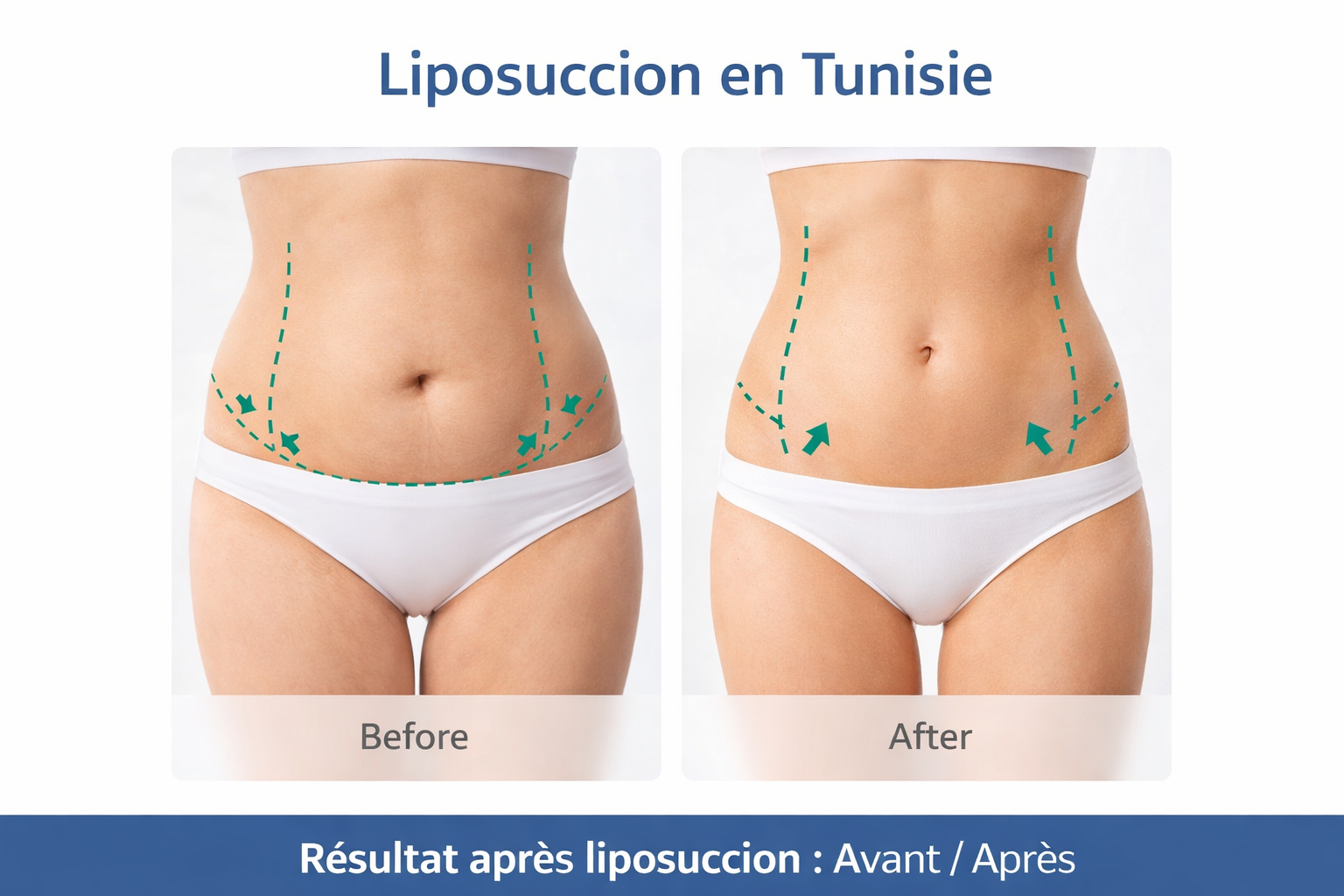 Résultat d’une liposuccion en Tunisie avant après avec remodelage de l’abdomen et affinement de la taille