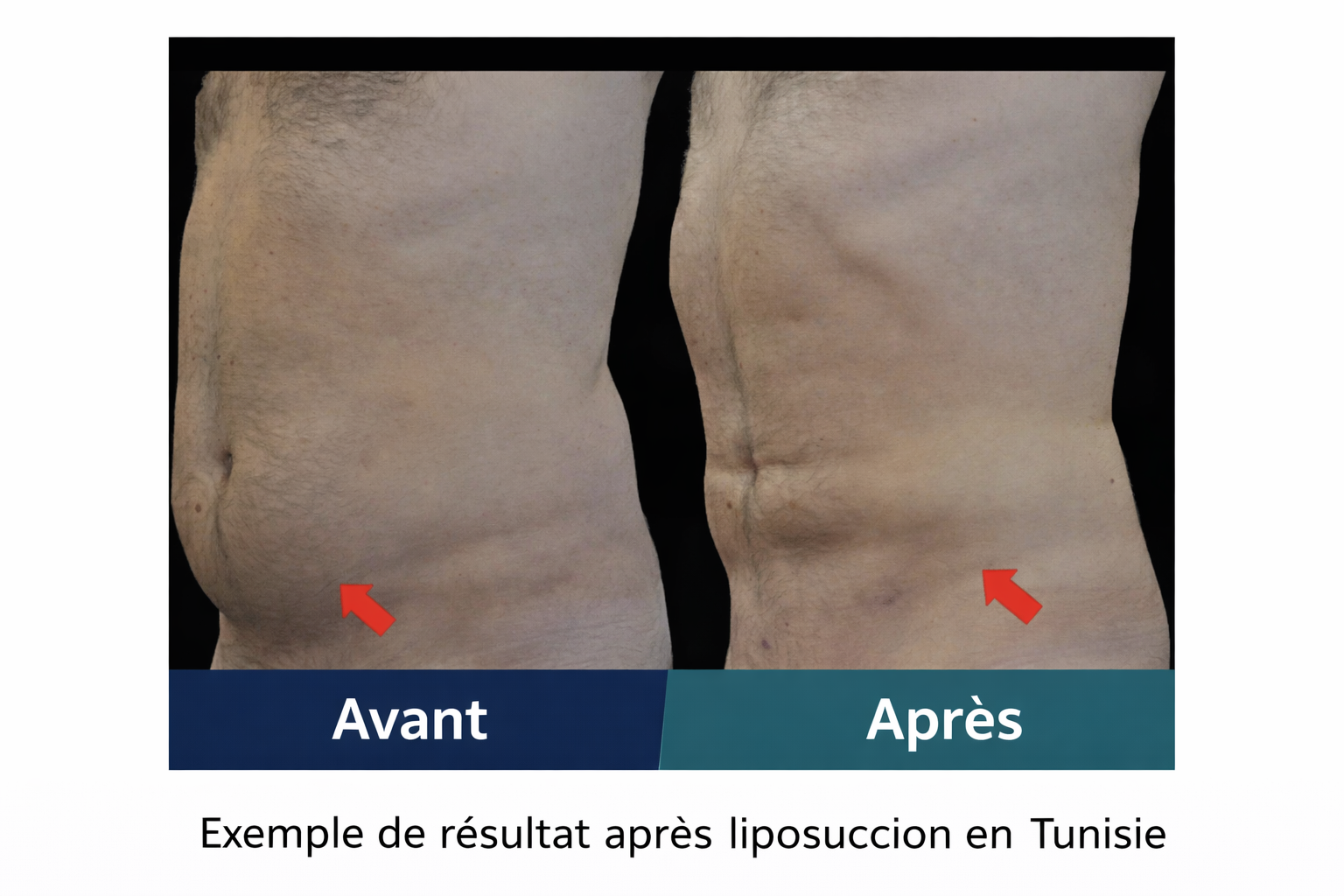 Combien de zones peut-on traiter avec une liposuccion en Tunisie ?